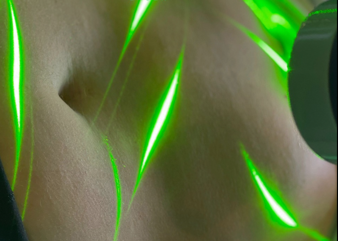 Laser verde para tratamento de perda de gordura