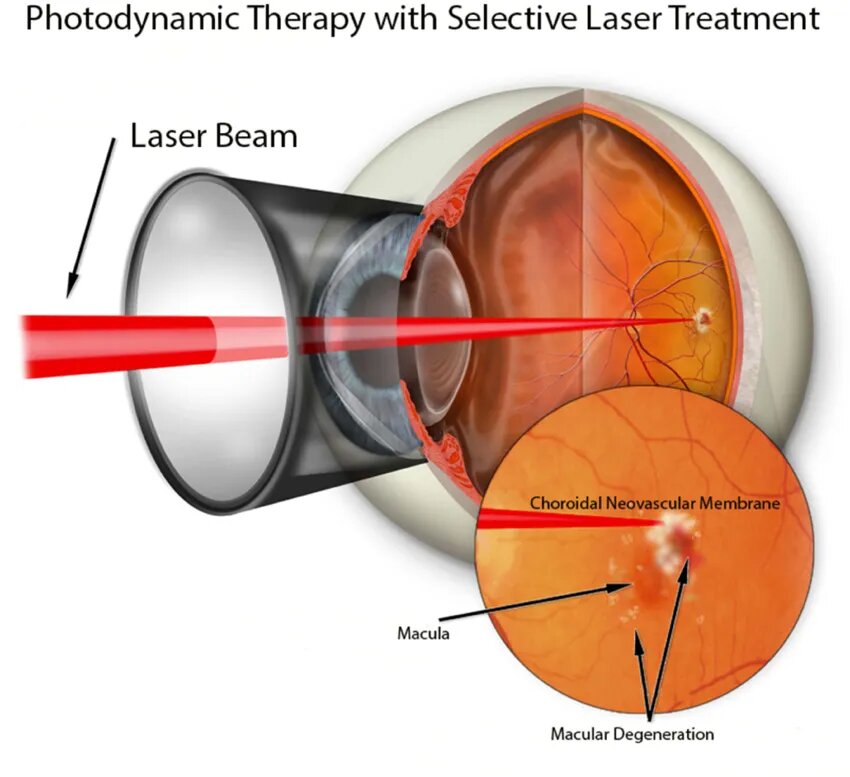 Depi&ccedil;&atilde;o gr&aacute;fica-de-depic&ccedil;&atilde;o-da luz focada em uma coroidal-neovascular-membrana na aplica&ccedil;&atilde;o
